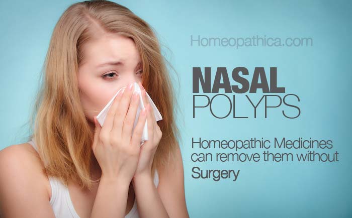 Remedy nose polyps home How to